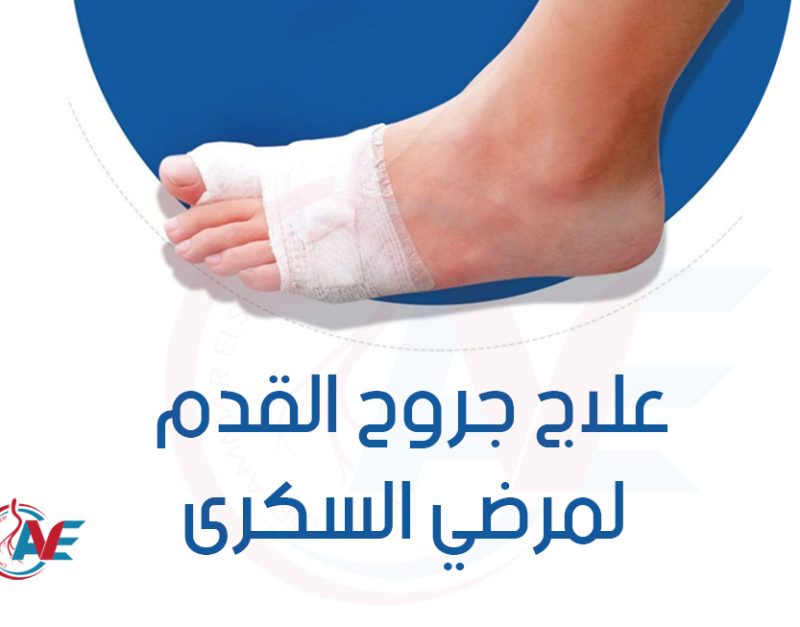 علاج جروح القدم السكري