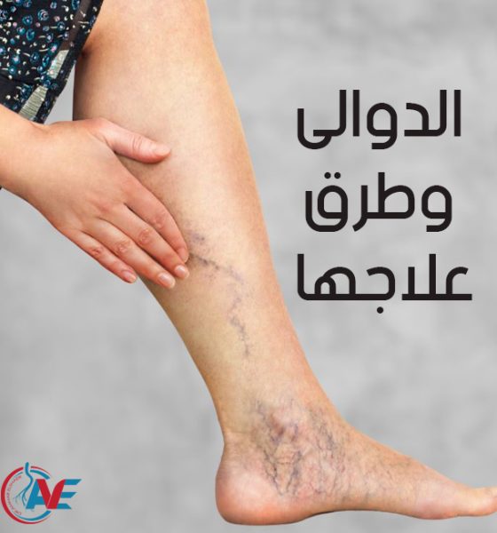 الدوالى وطرق علاجها